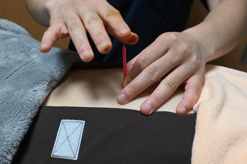 背中に鍼をしている様子