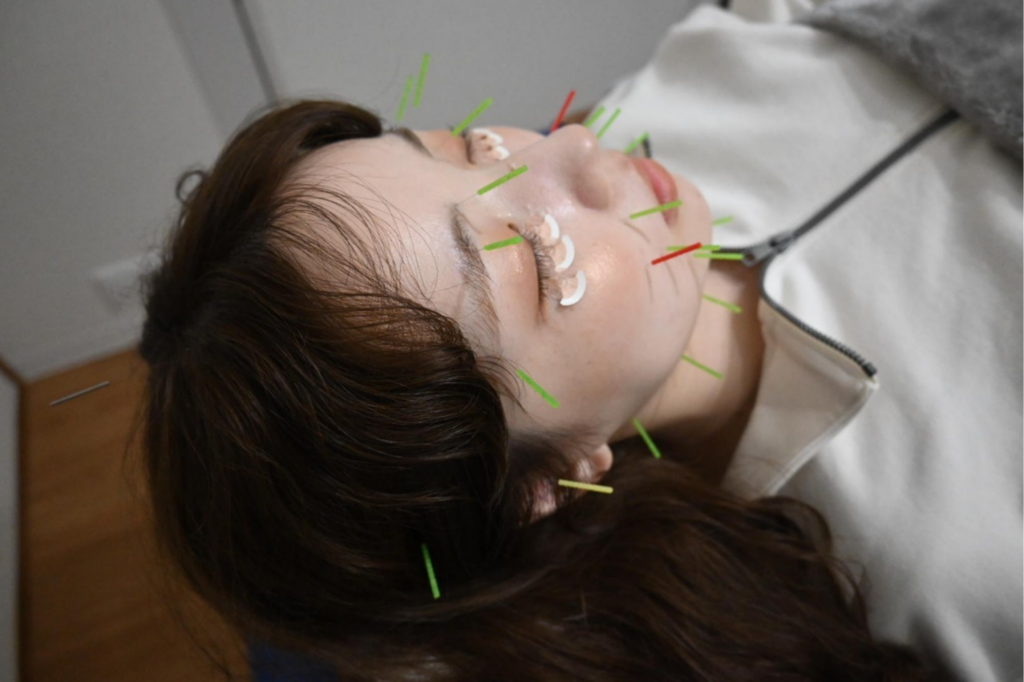 当院にて美容鍼の施術を受けた方のお写真。お顔に複数本の鍼が刺さっています。